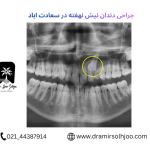 جراحی نیش نهفته در سعادت آباد