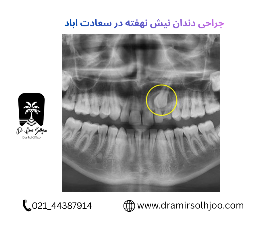 جراحی نیش نهفته در سعادت آباد