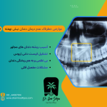 جراحی دندان نیش نهفته در گیشا