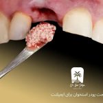 قیمت پودر استخوان برای ایمپلنت