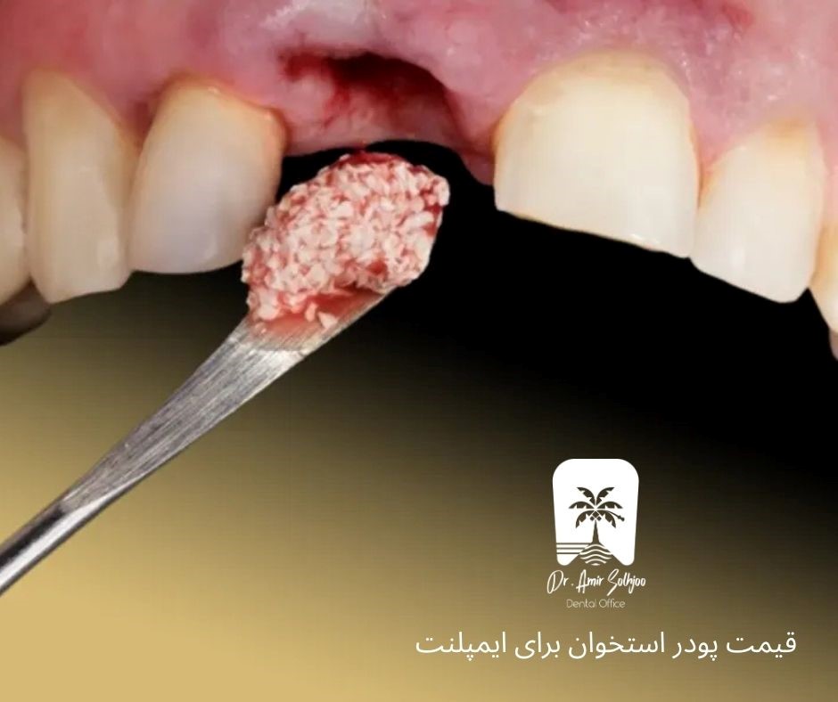 قیمت پودر استخوان برای ایمپلنت