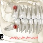 کشیدن دندان عقل در باغ فیض