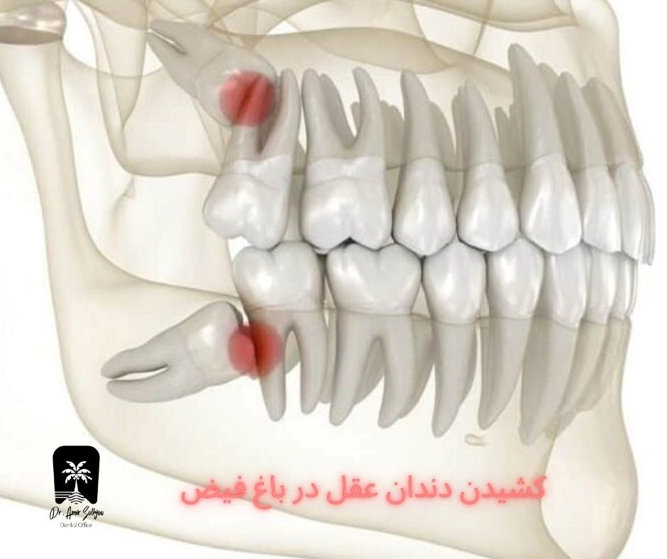 کشیدن دندان عقل در باغ فیض