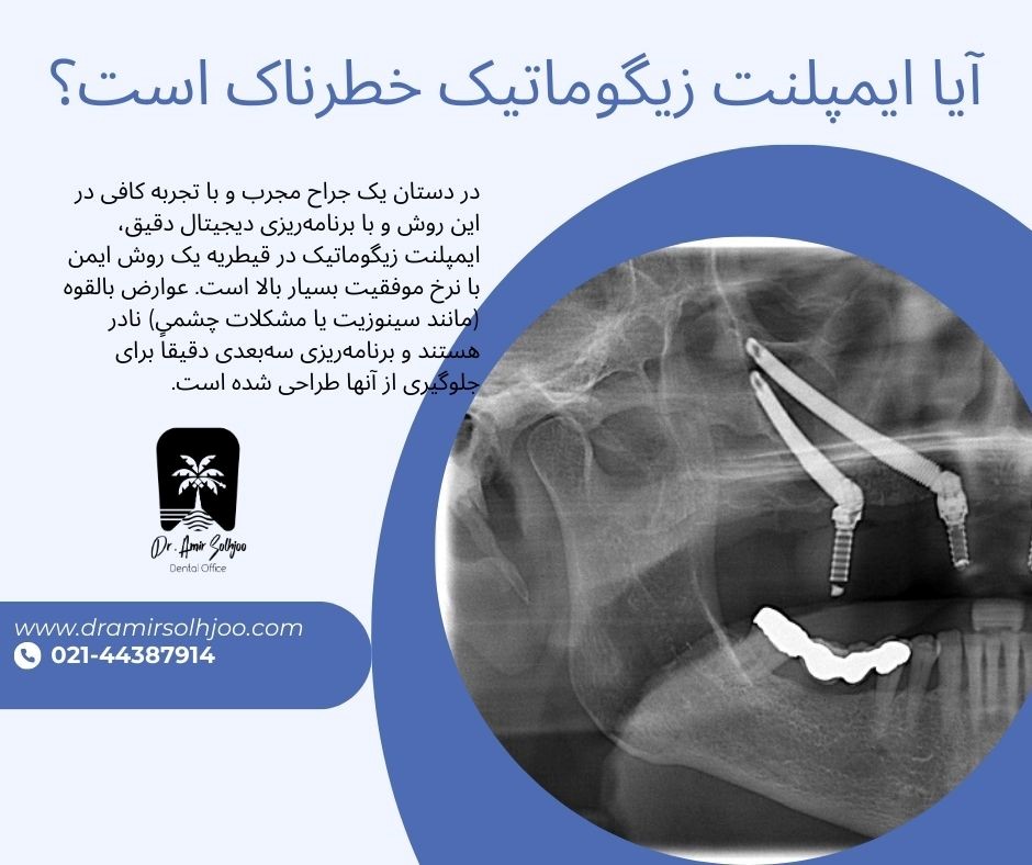 ایمپلنت زیگوماتیک در قیطریه