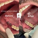 قیمت روکش ایمپلنت ۱۴۰۴