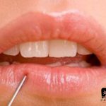 بی حسی لب بعد از ایمپلنت