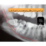 جراحی دندان عقل روی عصب در شهرک غرب
