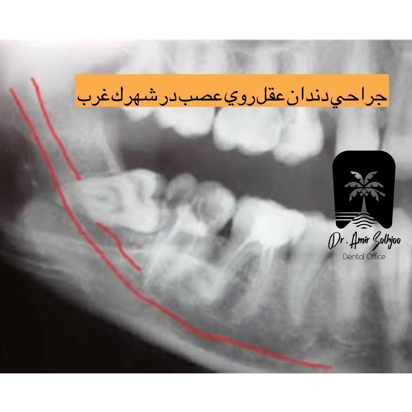 جراحی دندان عقل روی عصب در شهرک غرب