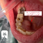 زائده استخوانی در لثه پایین