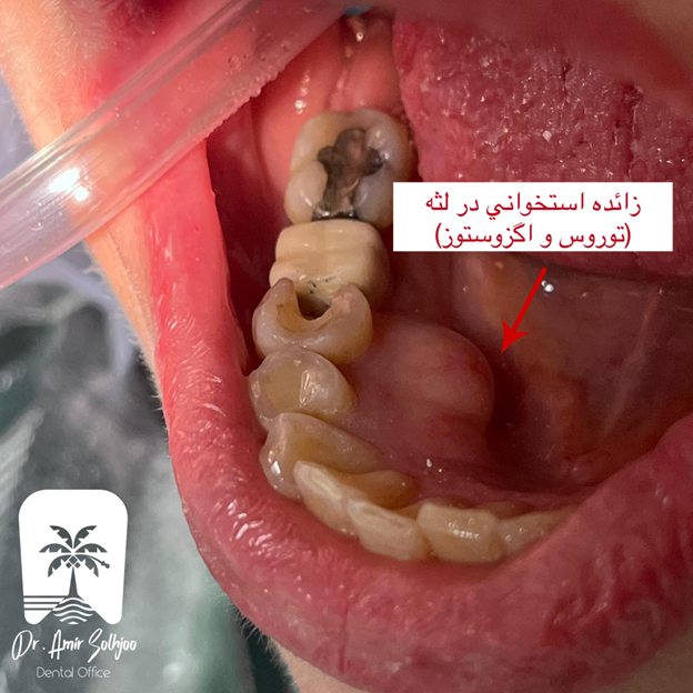 زائده استخوانی در لثه پایین