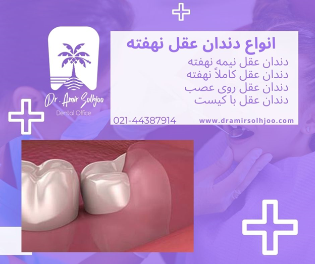انواع دندان عقل نهفته
