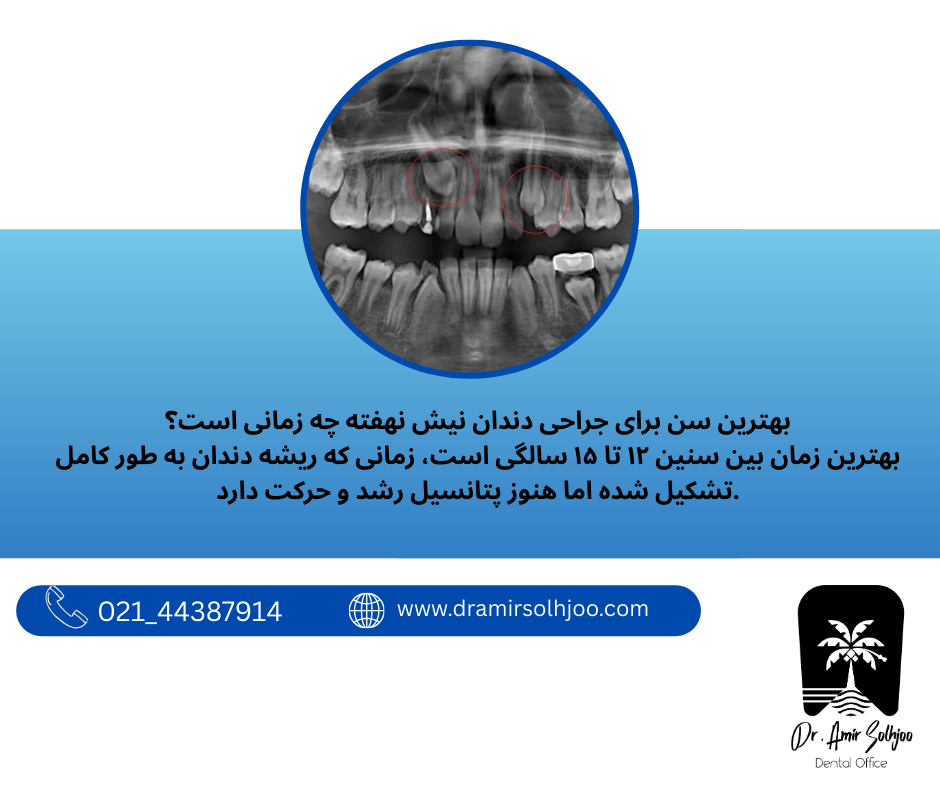 جراحی دندان نیش نهفته در گیشا