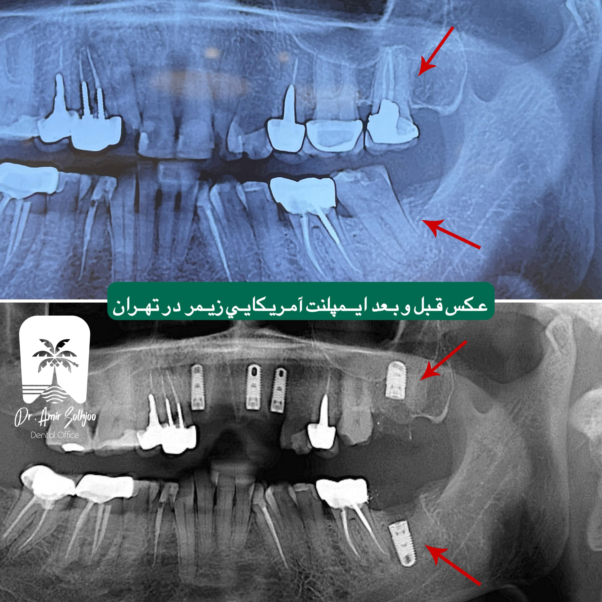 انواع ایمپلنت آمریکایی