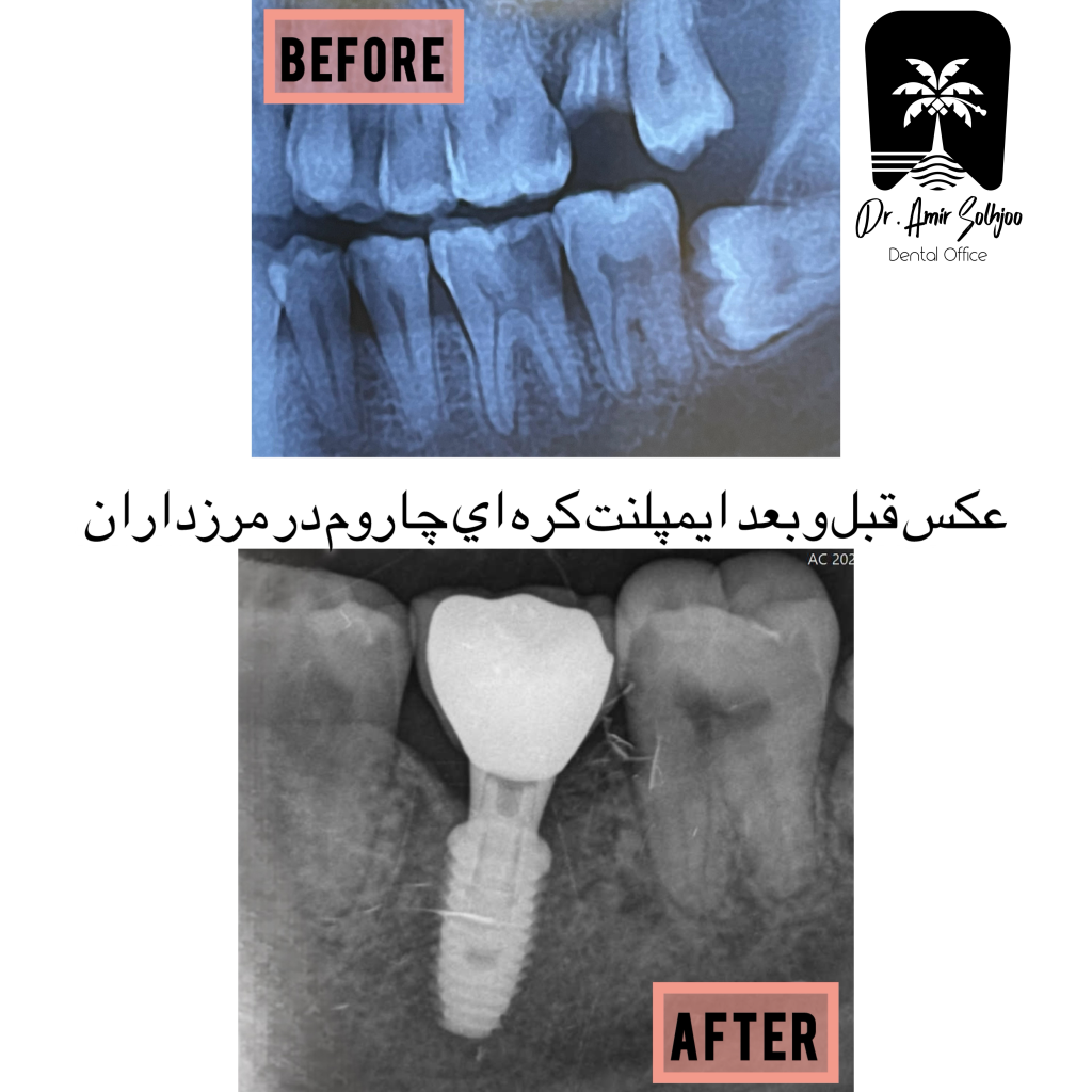 قیمت ایمپلنت در کلینیک مدرن