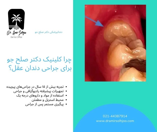 جراحی دندان عقل نیمه نهفته، نهفته و روی عصب