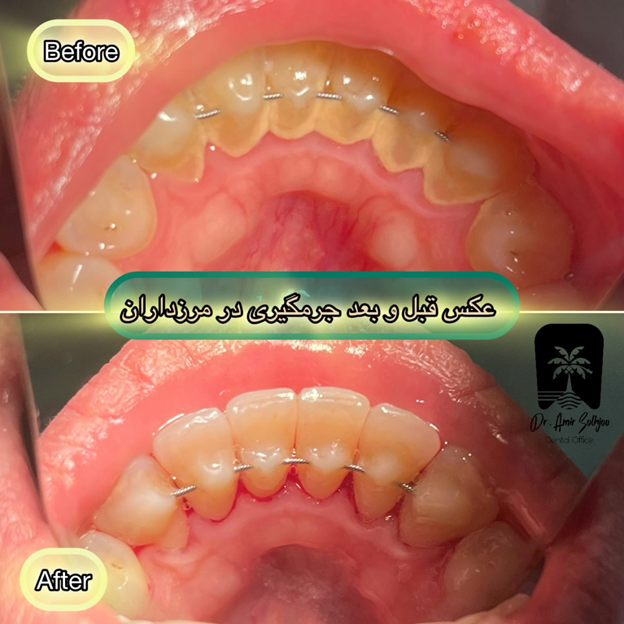 جرمگیری دندان در شهرک آزمایش و پاس فرهنگیان