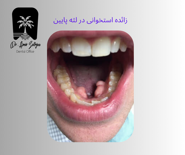 زائده استخوانی در لثه پایین