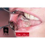 جراحی سرطان دهان