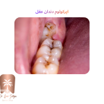اپرکولوم دندان عقل