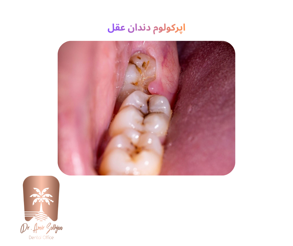 Wisdom tooth operculum