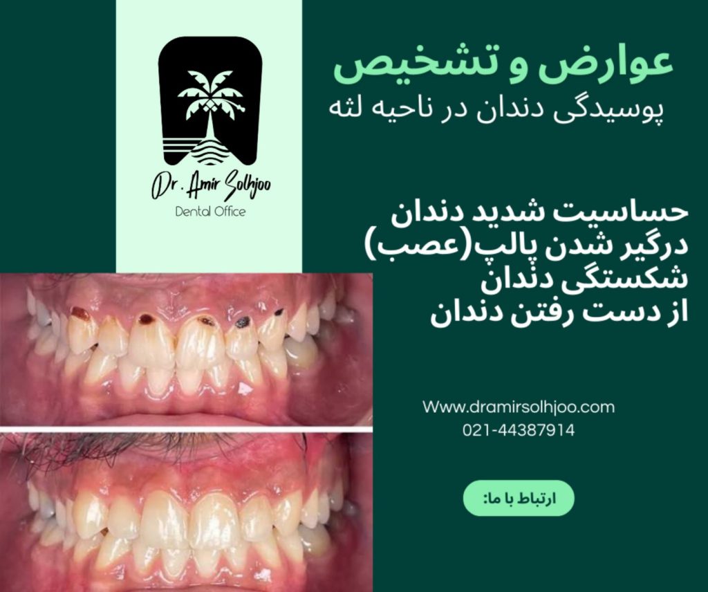 علت پوسیدگی دندان از کنار لثه