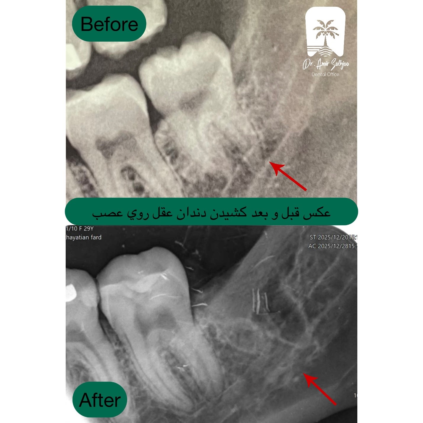 جراحی دندان عقل روی عصب در سعادت آباد