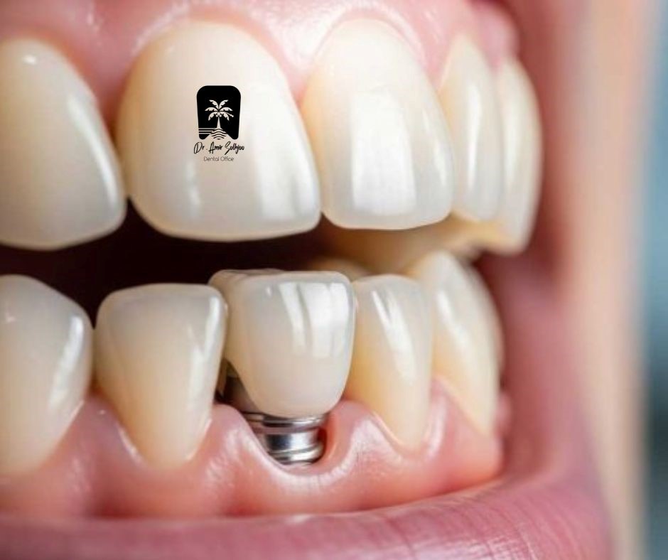 تحرير تخطيط الابتسامة مع الغرسات