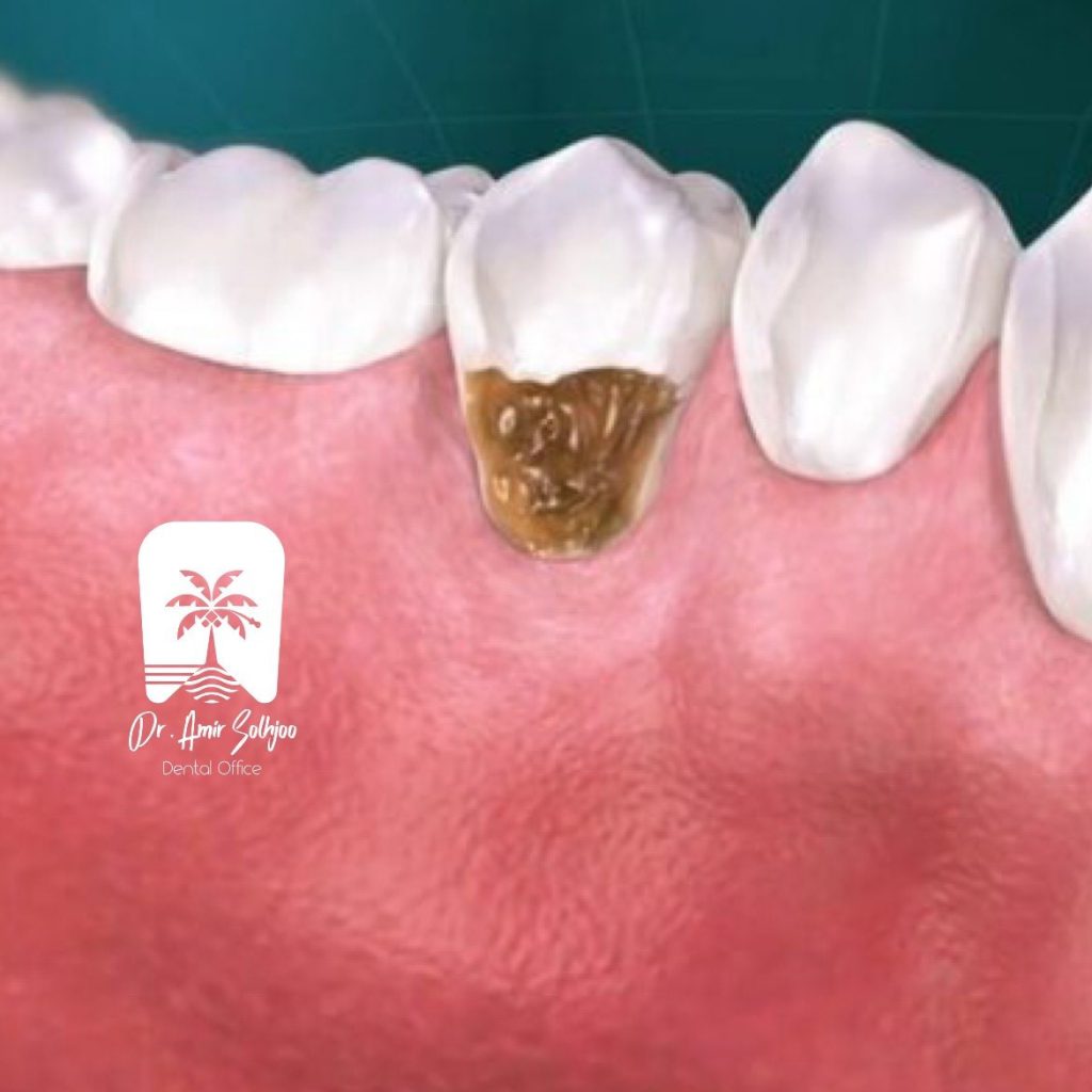 علت پوسیدگی دندان از کنار لثه