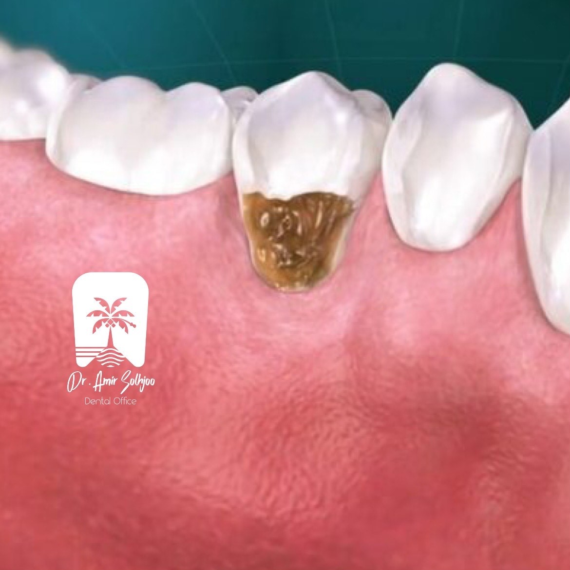 علت پوسیدگی دندان از کنار لثه