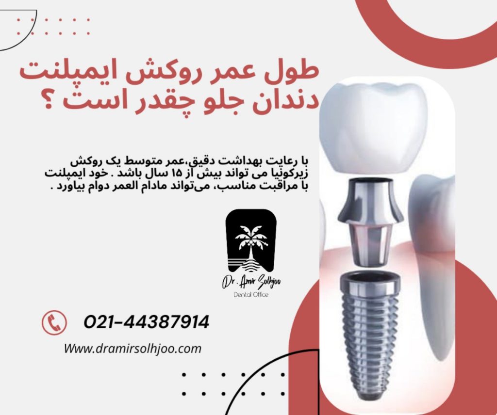 روکش ایمپلنت دندان جلو