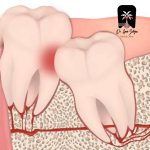 جراحی دندان عقل روی عصب در شهرک غرب