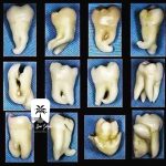 جراحی دندان عقل نیمه نهفته ، نهفته و روی عصب در گیشا