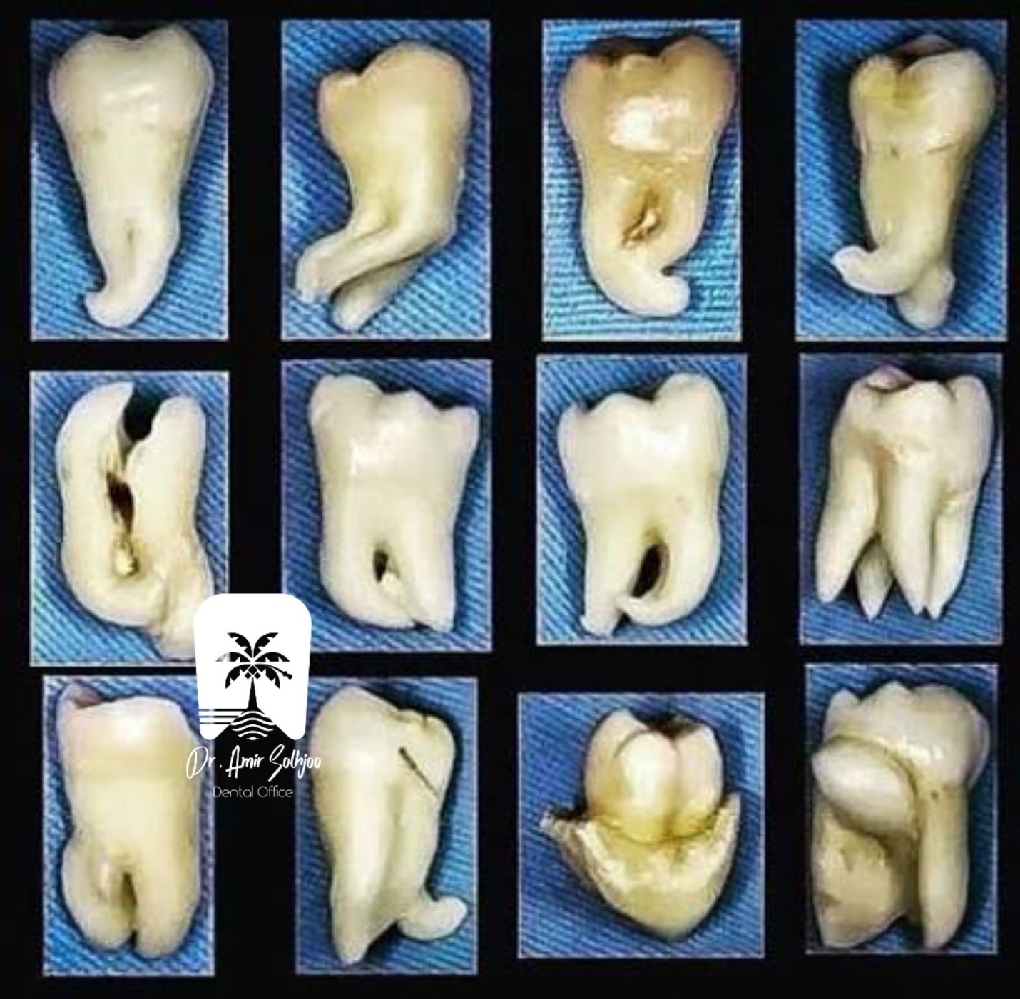 جراحی دندان عقل نیمه نهفته ، نهفته و روی عصب در گیشا