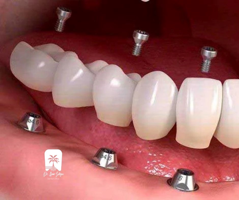implant Teeth in Nazi Abad
