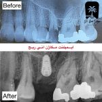 ایمپلنت مگاژن انی ریج