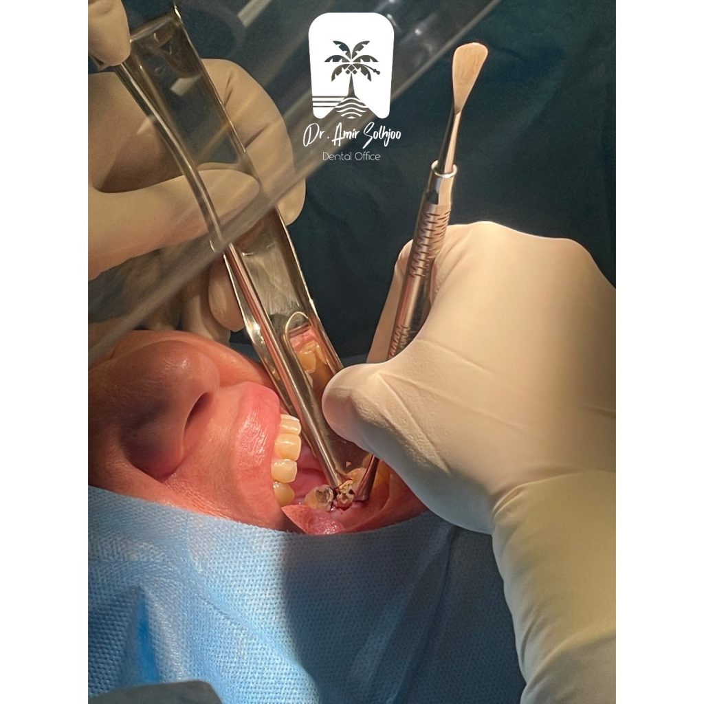 جراحی دندان عقل روی عصب در سعادت آباد