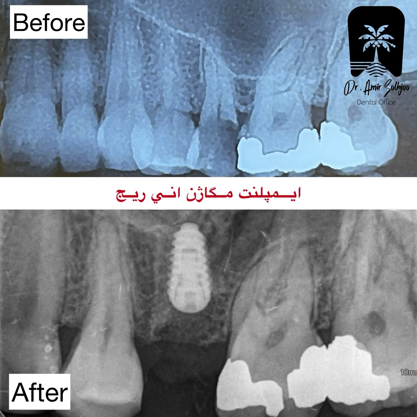 ایمپلنت مگاژن انی ریج
