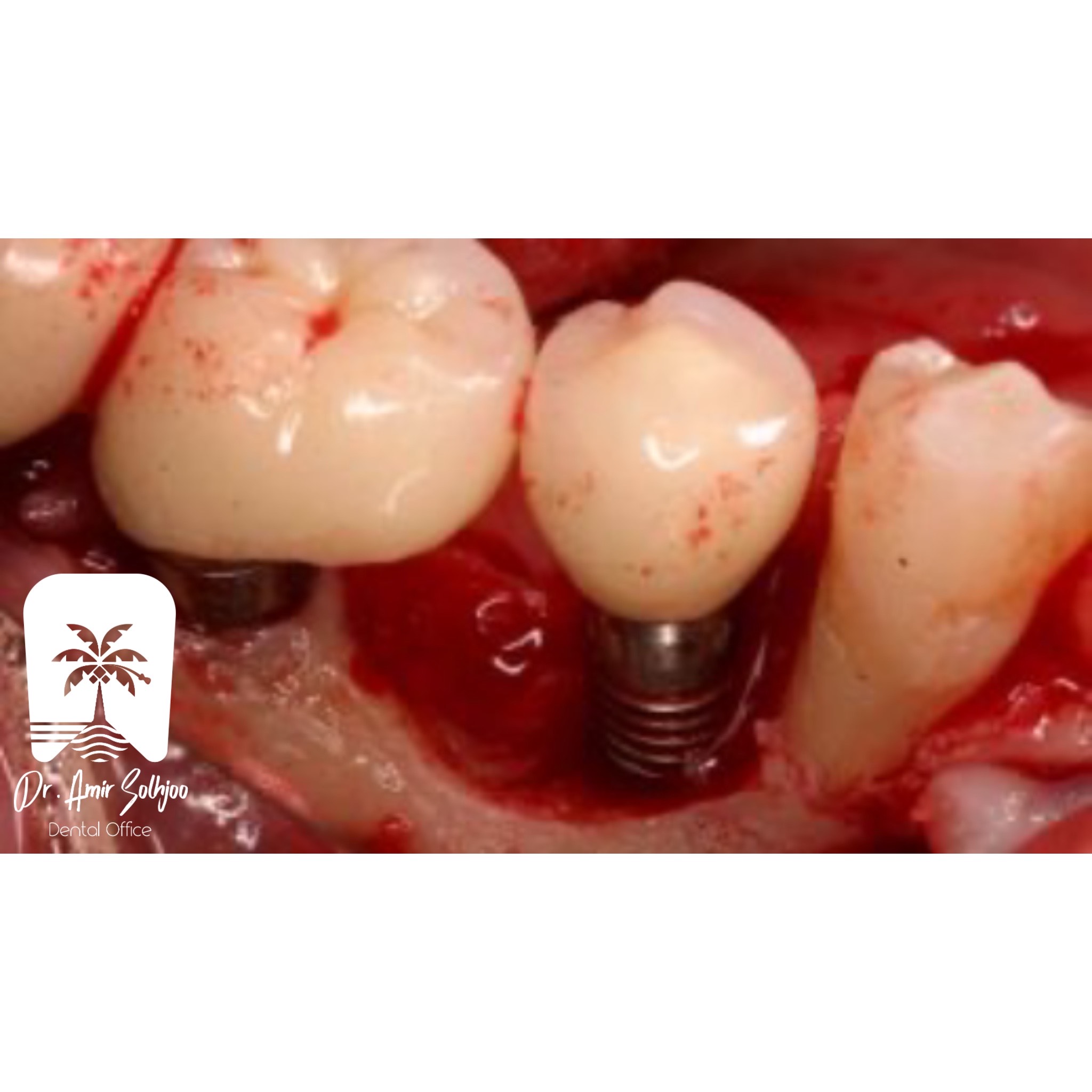 ایمپلنت ایرانی