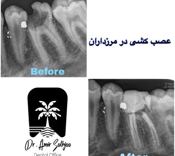 قیمت عصب کشی چهارکاناله