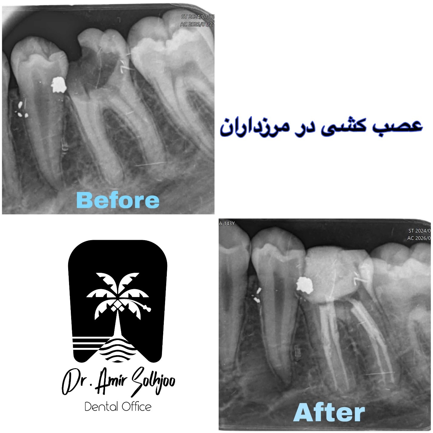 قیمت عصب کشی چهارکاناله