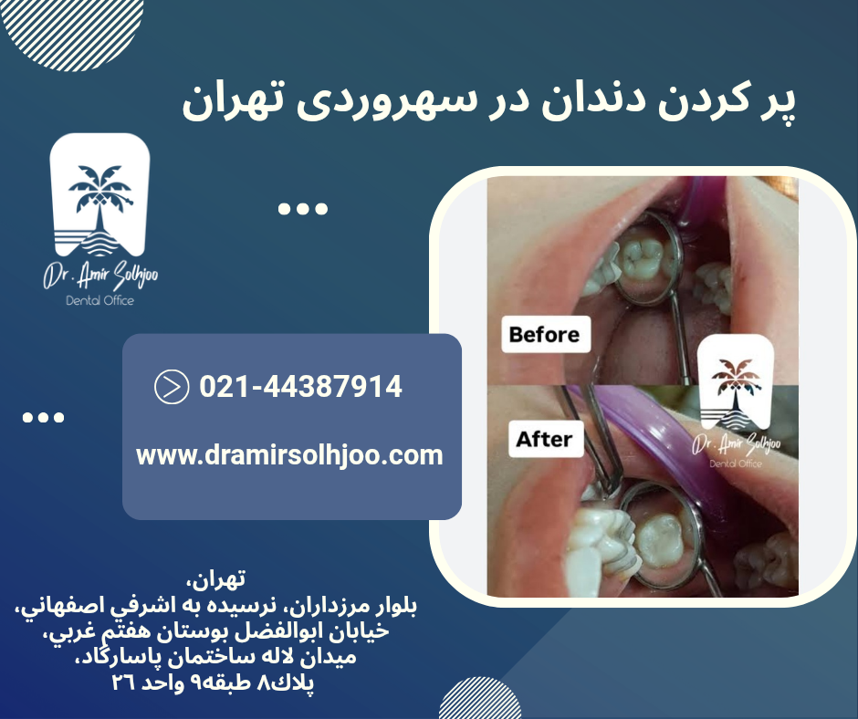 پرکردن دندان در سهروردی تهران