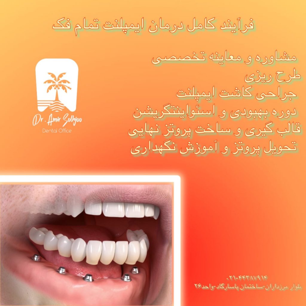 ایمپلنت تمام فک