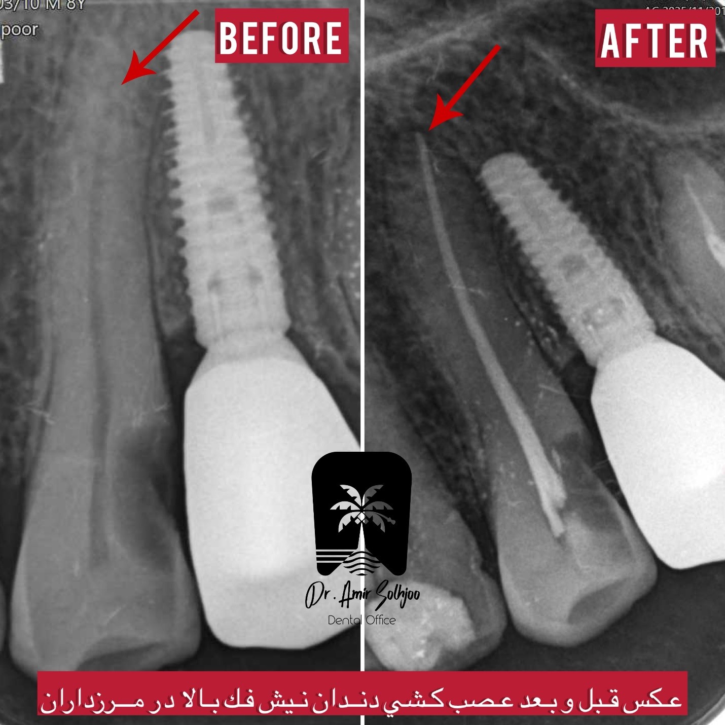 بهترین دندانپزشک برای عصبکشی