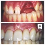 پیشگیری از تحلیل استخوان فک