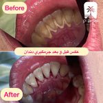 تعرفه جرمگیری دندان شمال تهران