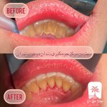 تفاوت جرمگیری و بروساژ