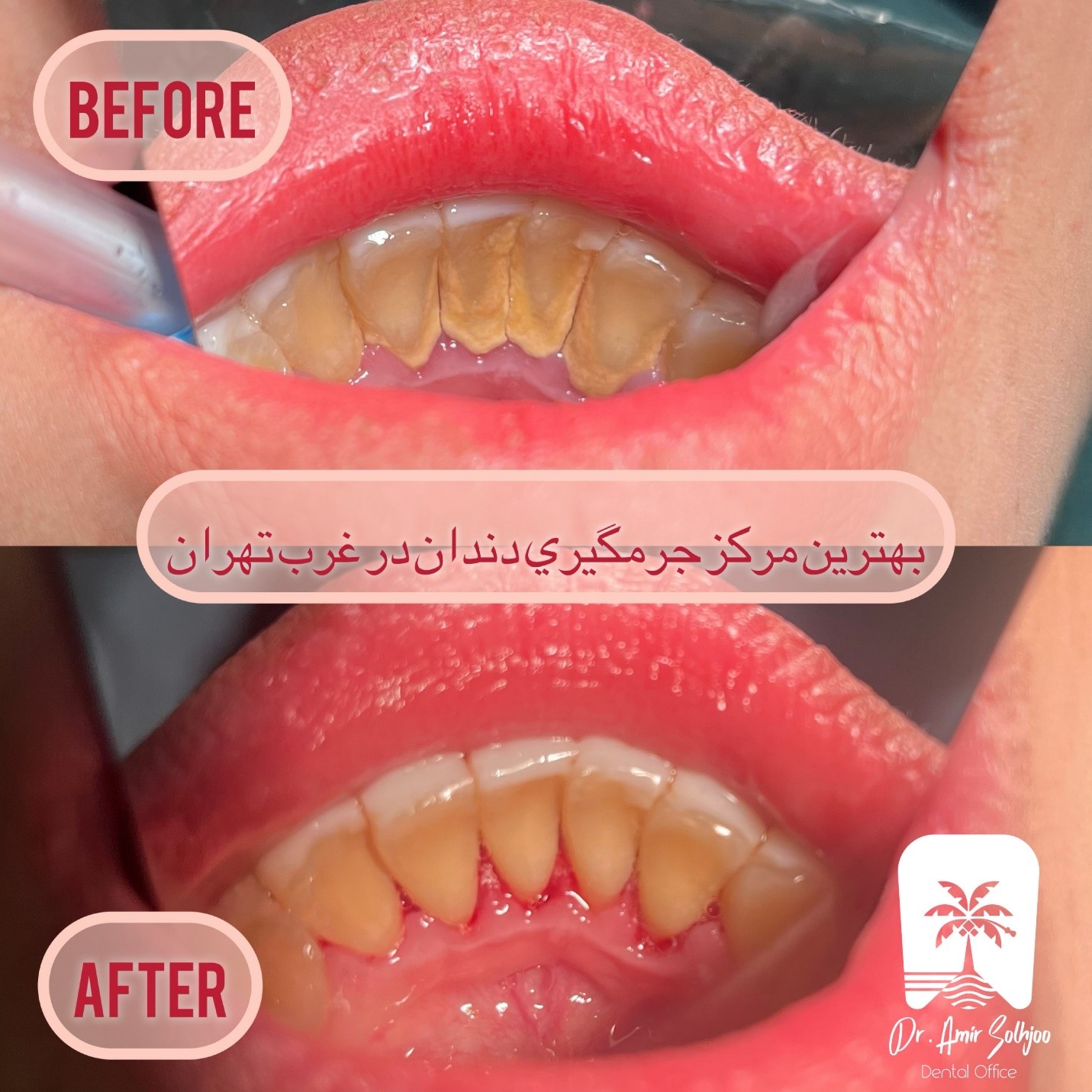 تفاوت جرمگیری و بروساژ