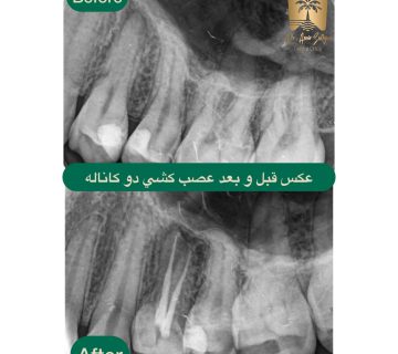 قیمت عصب کشی دوکاناله