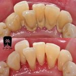 دستگاه جرمگیری دندانپزشکی