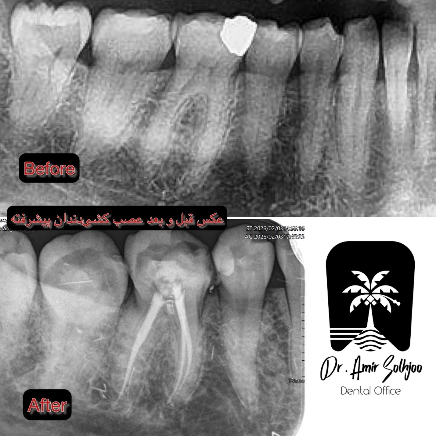روشهای پیشرفته در عصبکشی